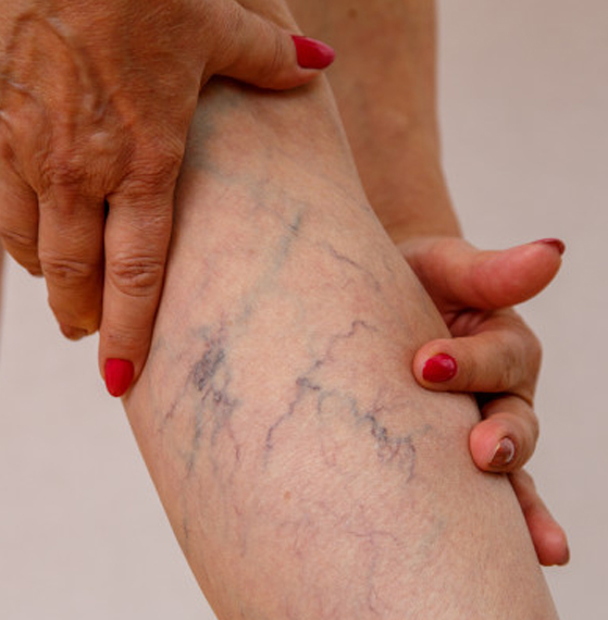 Angiología várices