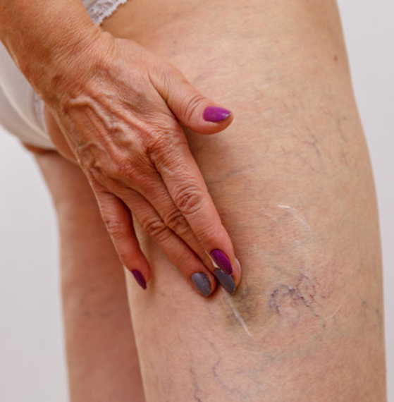 Angiólogo cerca de mí