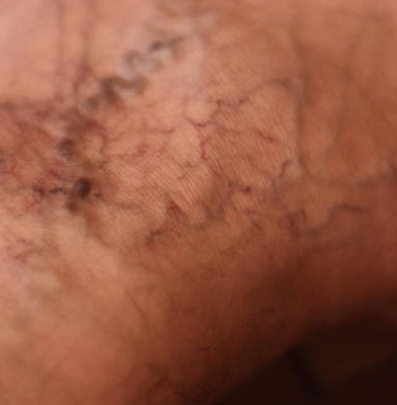 Angiólogo en Gustavo A. Madero