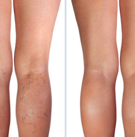 Eliminación de várices