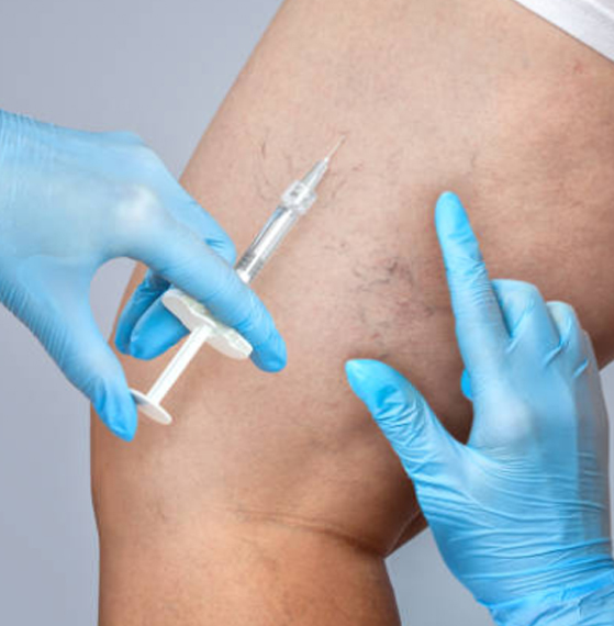 Escleroterapia precio