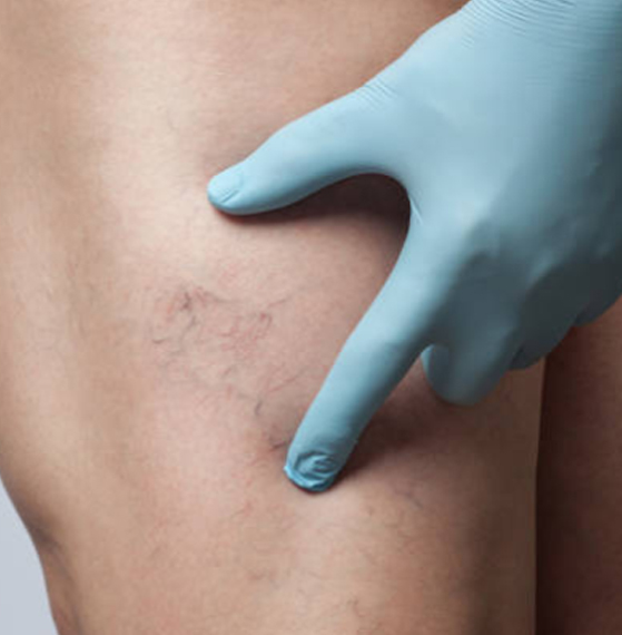 Precio de escleroterapia